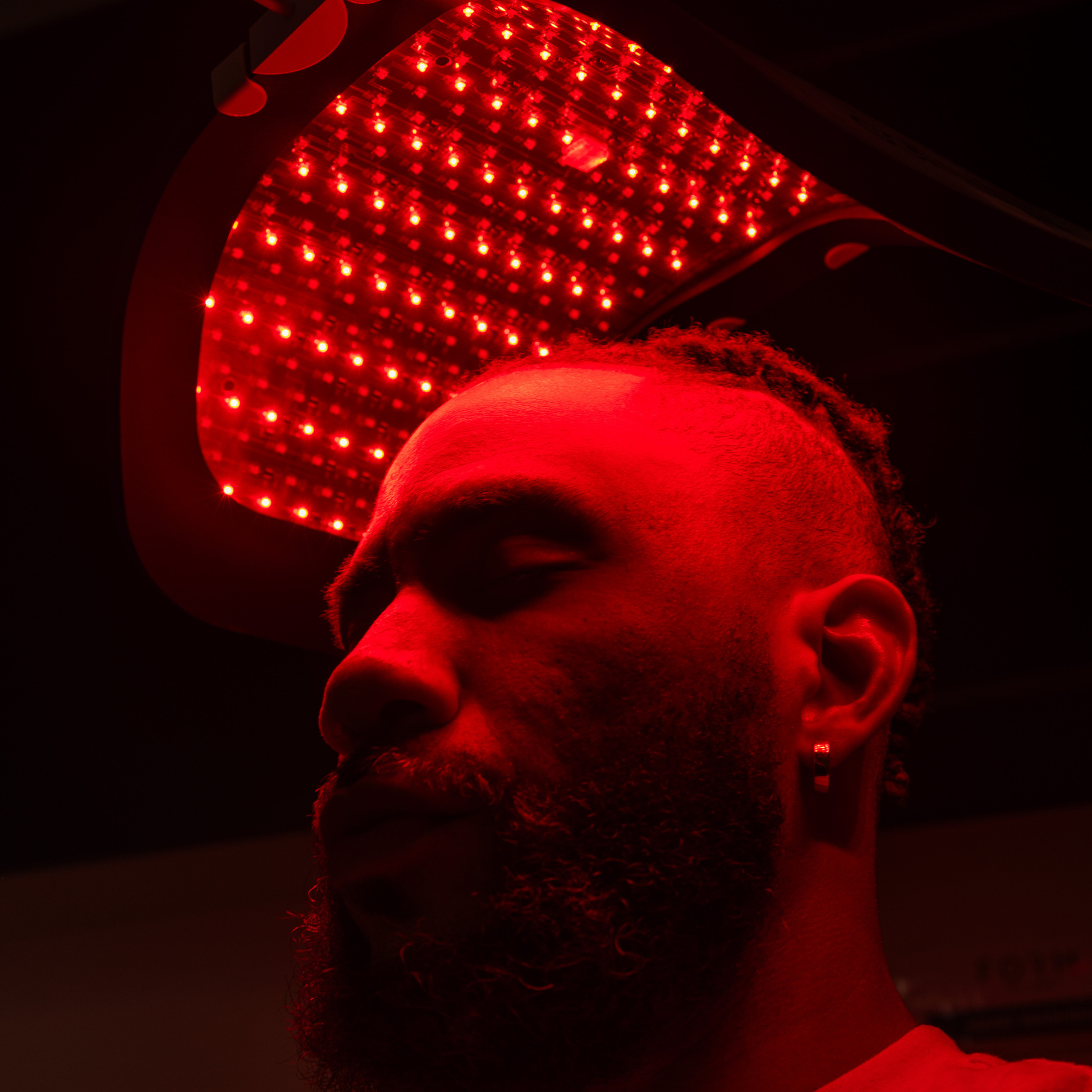 FUE Hair Transplant