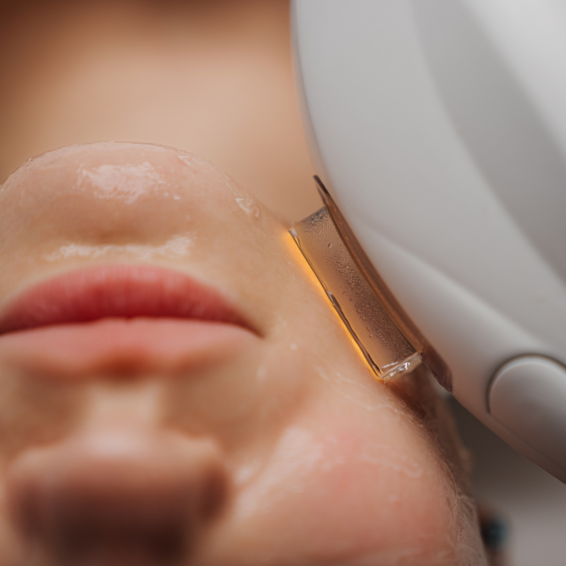 IPL Treatment