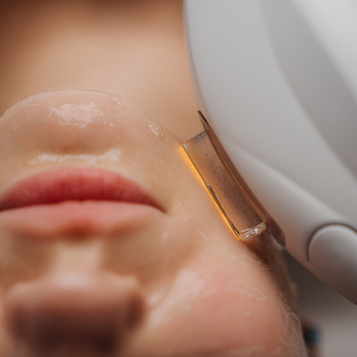 IPL photofacial treatment at FORM