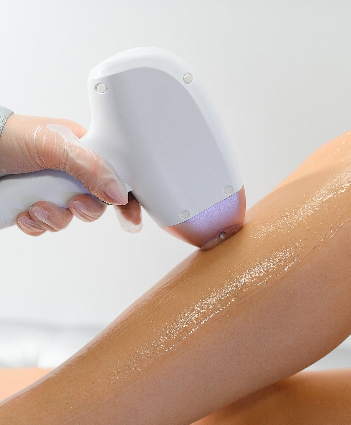 Laser hair removal treatment